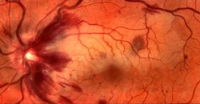 retina kan damarları ve görme restorasyonu